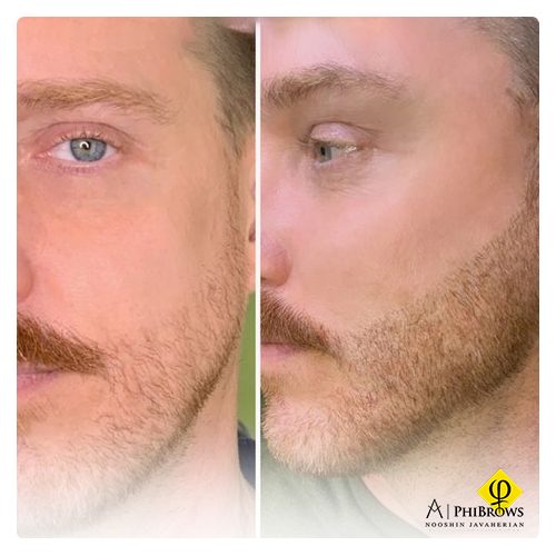 Microblading beard Last