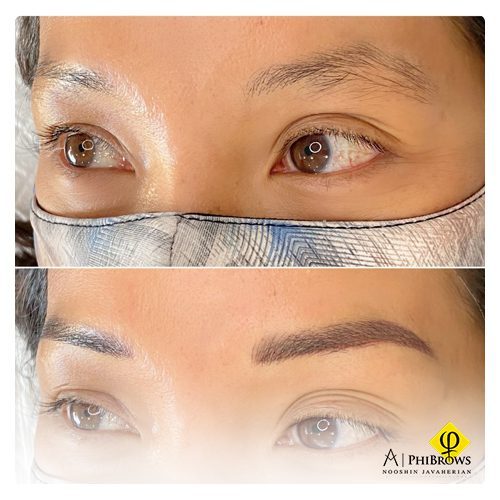 Microblading laser Removal